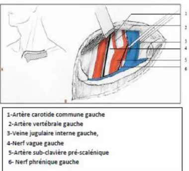 Figure 14:  Cléidectomie partielle permettant d’exposer la partie proximale de l’artère sous- sous-clavière pré-scalénique  