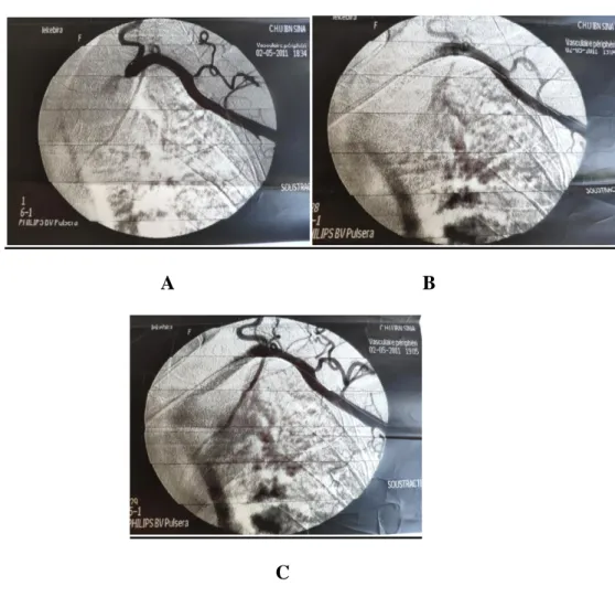 Figure 18: Recanalisation endovasculaire d’une sténose de l’artère sous-clavière gauche  prévertébrale par voie radiale