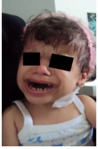 Figure 1 : Photo de la fille L.A à l’âge de 1 ans (unité de cardio -pédiatrie à L’Hôpital  d’Enfant de Rabat)