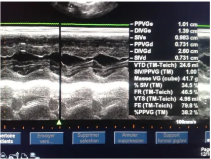 Figure 3 : Ventricule gauche en mode TM : hypertrophie du septum inter ventriculaire  du VG (unité de cardio -pédiatrie à L’Hôpital d’Enfant de Rabat)