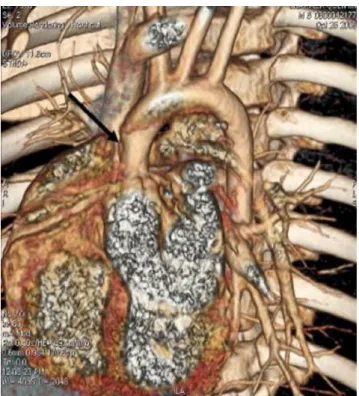 Figure 10- Scanner multi détecteur : reconstruction tridimensionnelle d’une sténose  aortique supra valvulaire indiquée par la flèche noire