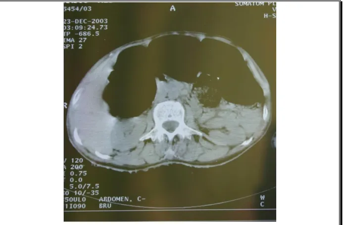 Fig. 2 : TDM abdominal : 