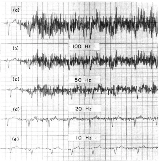 Fig.  XXIII-8. Effects  of  24  dB/octave  lowpass  filtering  of  an  excessively  noisy  EKG.