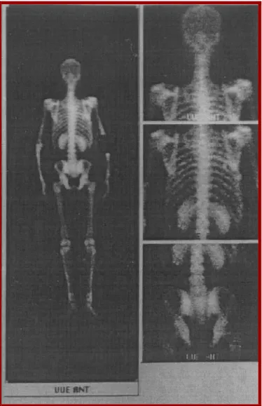 Figure 5 : Scintigraphie osseuse objectivant une hyperfixation articulaire   typique d’une ostéo-arthropathie pneumique de Pierre Marie