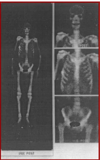 Figure 6 : Scintigraphie osseuse objectivant une hyperfixation articulaire   typique d’une ostéo-arthropathie pneumique de Pierre Marie