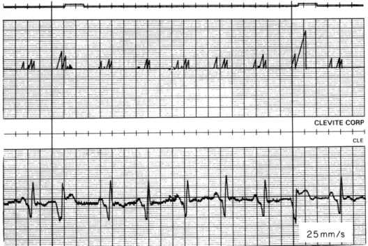 Fig.  XXVII-8. Waveform  of  ramp  generator.  The  output  of  the  ramp generator  is  shown  above  the  EKG  signal  used  as  an  input to  the  PVC  detector