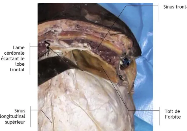 Fig. 34 : Vue cadavérique anterieure du crâne montrant le toit de l’orbite   après écartement du lobe frontal (voie extradurale)