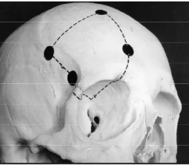 Fig. 36 : Voie sous-frontale extradurale droite avec dépose du rebord orbitaire  