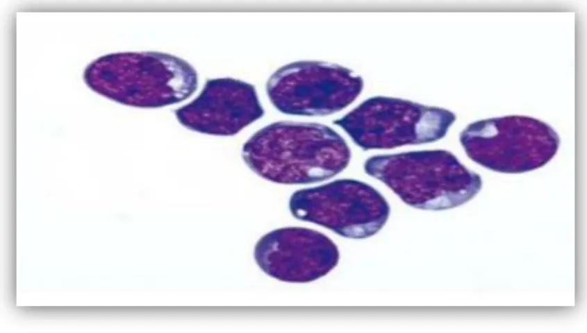 Figure 4 : Aspect des blastes type  L3 