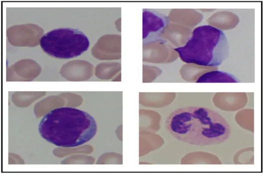 Figure 6 : Sous-types selon la classification FAB. (A) type L1, (B) type L2, (C) type L3, (D) Une cellule non  cancéreuse L3 Type ALL