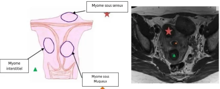 Figure 7: IRM, les troix types de myomes. 