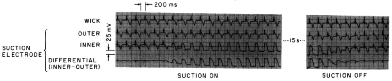 Fig.  VIII-5.  Wick  electrode  and  suction  electrode  (outer  to  ground,  inner to  ground),  differential  (inner-outer)  suction  turned  on  and  off.