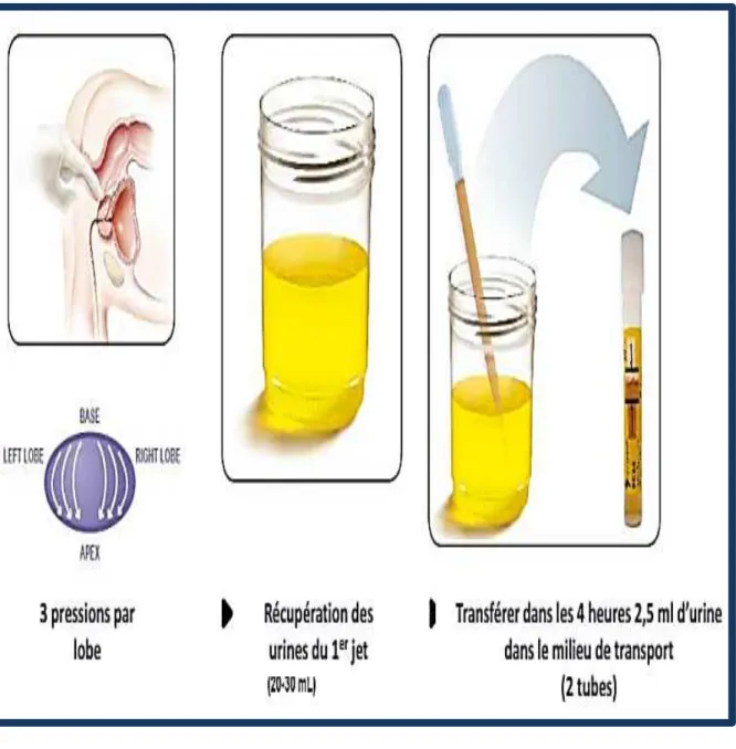 Figure 8.Collecte des urines[67] 