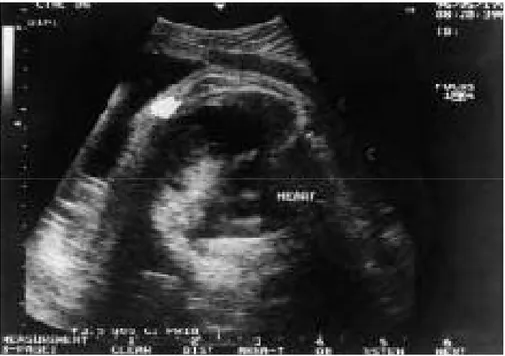 Figure 2 : Section transversale du thorax d’un fœtus. Une masse intrathoracique  Héteroéchogéne peut être identifié dans un kyste comme «une balle dans un trou  