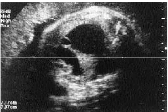 Figure 3 : Une énorme (7,2 × 7,6 × 5,5 cm) tumeur multiloculaire hétérogène   a été noté dans la cavité de la poitrine à droite à 36 semaines de gestation
