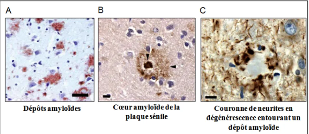 Figure  9 :  Dépôts  amyloïdes  et  plaques  séniles.  A.  Dépôts  amyloïdes  observés  par  immuno-histochimie à l’aide d’un anticorps anti Abeta (Alafuzoff et al., 2009) B