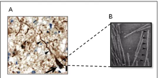 Figure 11: Dégénérescences neurofibrillaires observées dans la MA.  A. Neurone en  DNF par immunohistochimie à l’aide d’un anticorps anti-pTau (AT8) (Duyckaerts et al