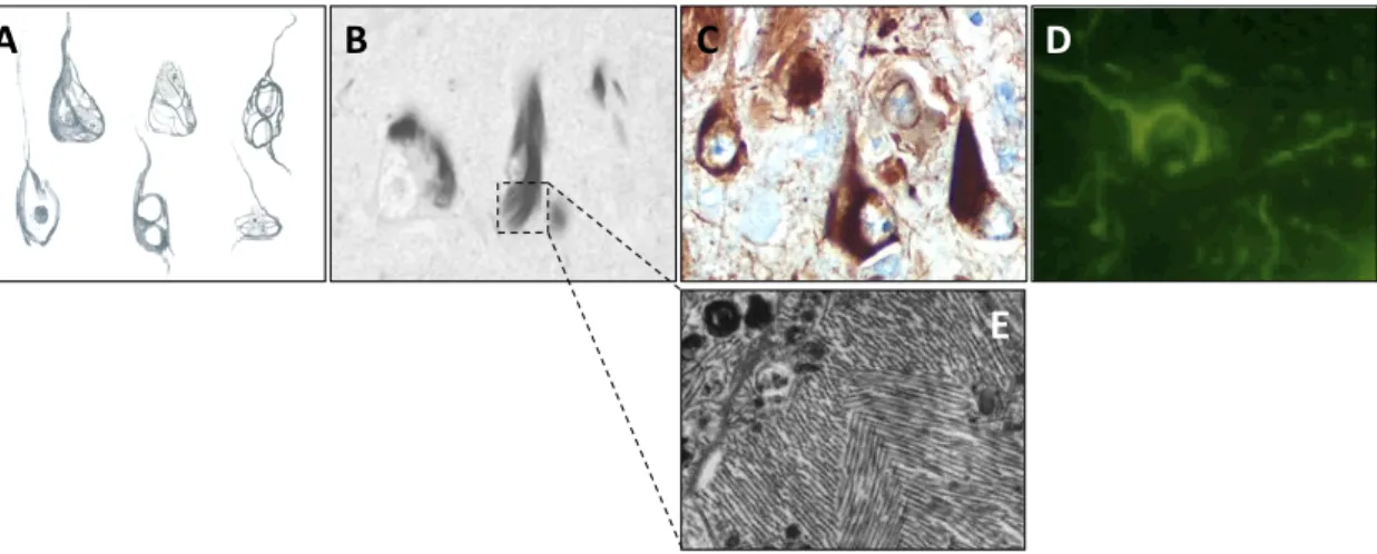 Figure 10 : Aspects microscopiques de la dégénérescenceneurofibrillaire et techniques de marquage : 