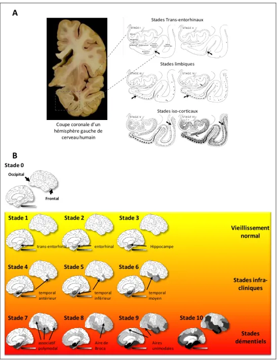 Figure 12 : Progression de la dégénérescenceneurofibrillaire au cours de la Maladie d’Alzheimer :  