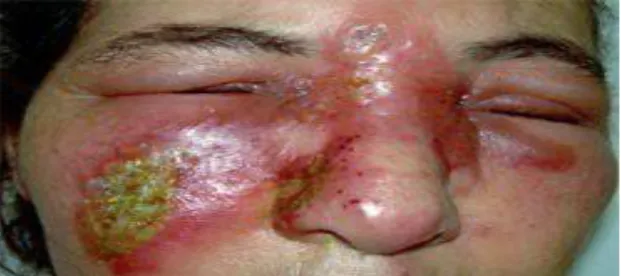 Figure 14 : image montrant l’aspect clinique d’une staphylococcie maligne de  La face [63] 