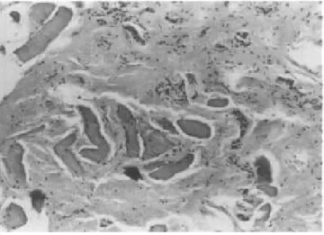 Figure 16:coupe histologique du muscle SCM montrant une raréfaction cellulaire  remplacée par la fibrose(15) 