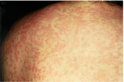 Figure 2 : Exanthème maculopapuleux dû  à l’amoxicilline  [65]