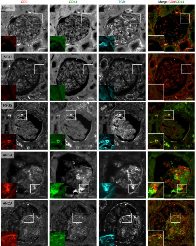 Fig. 7 In human, CD9 overexpression in pathological glomeruli is associated with CD44 and ITGB1 expression