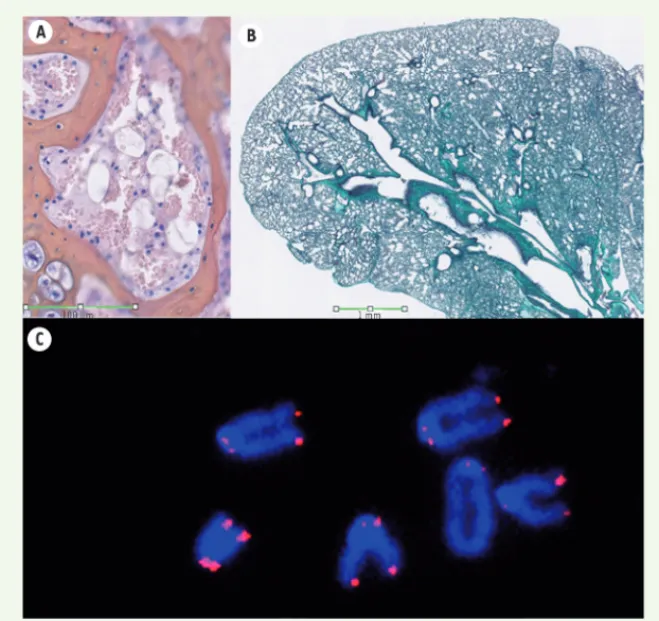 Figure 1. Les souris exprimant la p53 Δ31  pré- pré-sentent des caractéristiques de dyskératose  congénitale