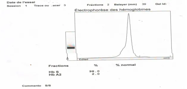 Figure . 33 b : Electrophorèse enfant drépanocytaire de 8 ans Hb 98%. 