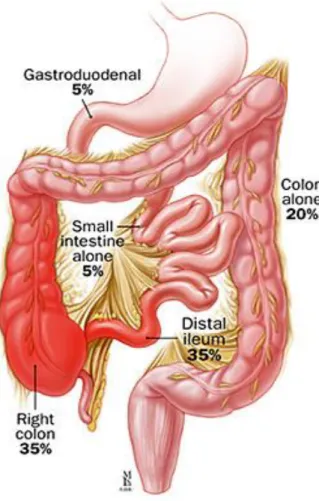Figure 3 : Localisation des lésions dans la maladie de Crohn. (Rasenack et al, 2010) 