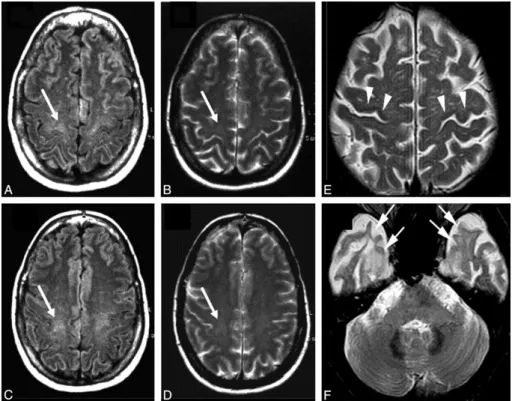 Figure 12: Hyperintensity at the subcortical precentral gyrus (A and B) and the centrum semiovale  (C and D) on FLAIR (arrows, A and C) and T2-weighted (arrows, B and D) images of a 66-year-old  patient with ALS