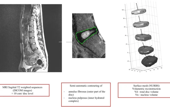 Fig. 2 3D reconstruction of the intervertebral disc from MRI T2 sagittal sequences