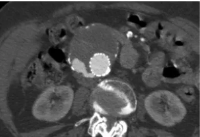 Figure 5. Angioscanner postopératoire montrant du produit de contraste dans l'anévrysme et en dehors de  l'endoprothèse signant la présence d'une endofuite 