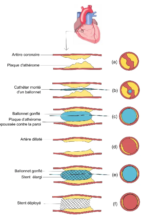 Figure 12: Schéma des étapes d'une angioplastie avec pose de stent. 