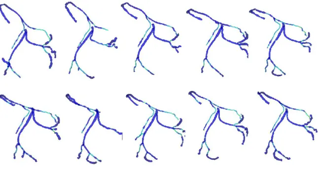 Figure 17 : Exemples de séquence d'arbres coronaires 3D droit et gauche représentant différents instants du cycle cardiaque  obtenus après modélisation 3D