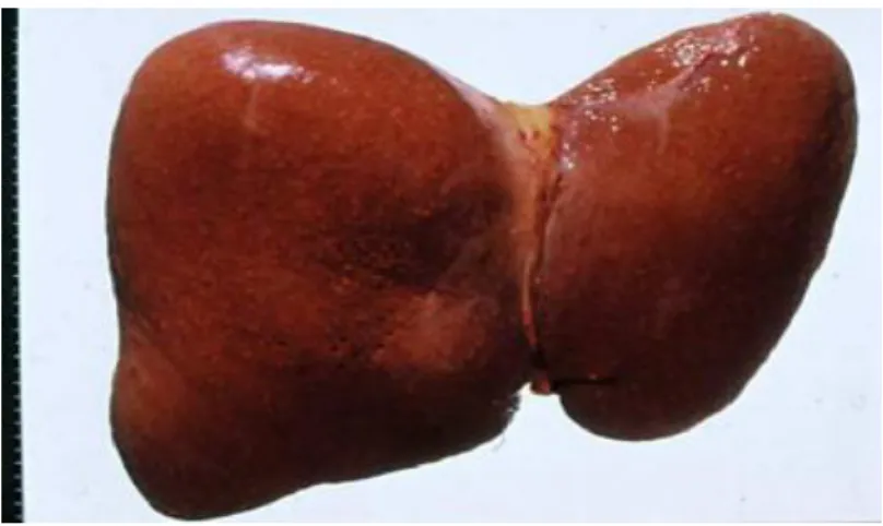 Figure 16 : foie cirrhotique (40). 
