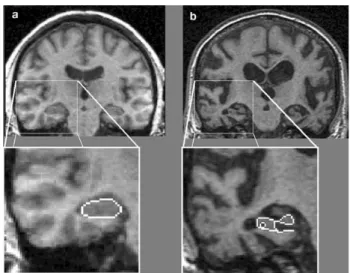 Figure 7 : IRM  en  coupe  coronale d’une personne  saine  (a)  et  d’un  patient  atteint  de  la  MA  (b)  montrant  l’atrophie  généralisée  du  cerveau  et  notamment  des  régions  hippocampiques