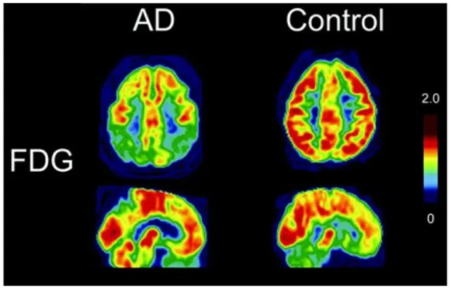 Figure 8 : Consommation du glucose dans le cerveau d’une personne saine et d’un patient atteint de la  MA  (AD)