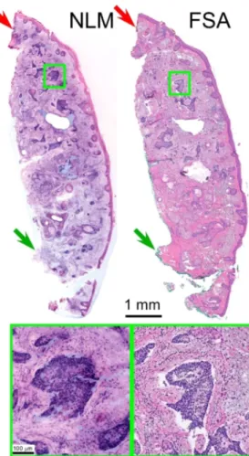 Fig. 3. Mohs margin with mixed nodular and infiltrative pattern BCC. Red surgical marking ink is visible along the top of the figure (red arrows) in both the NLM and FSA images, while green surgical ink (green arrow), which lacks fluorescence, is visible o