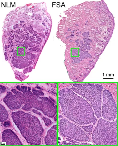 Fig. 4. Excision with large nodular BCC. The FSA section intercepts the edge of the tumor, while the NLM image is from a section tens of microns further into the tumor, showing a larger area of nodular BCC
