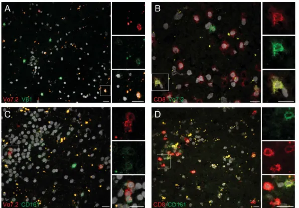 Figure 3 MAIT cells can be detected within parenchymal lesions of MS brain