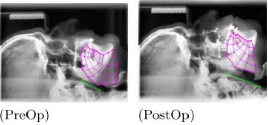 Fig. 1. Segmentation of the pre-operative (PreOp) and the post-operative (PostOp) radiographies of apneic patient no
