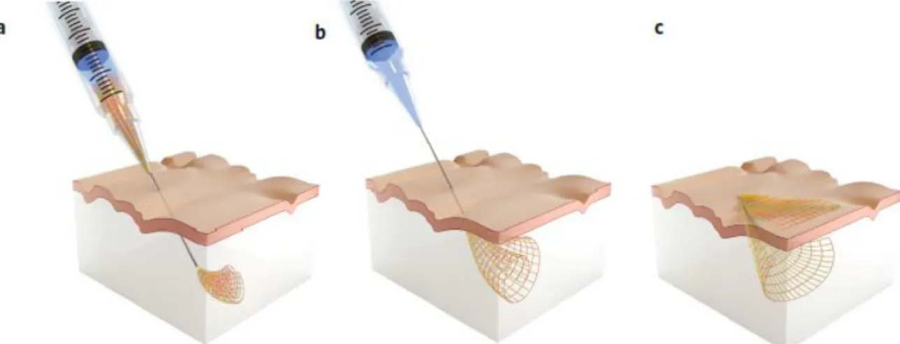 Figure 32: Injection d'un filet d'électrode dans le cerveau grâce à un ensemble seringue aiguille (Liu et al., 2015) 