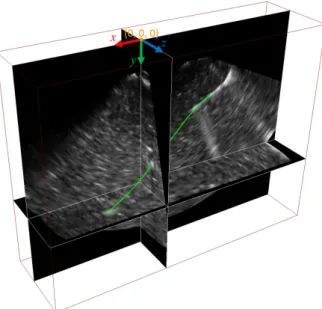 Figure 10: 3D US volume of a needle inserted in an Agar phantom. The volume is represented by three planar  sec-tions
