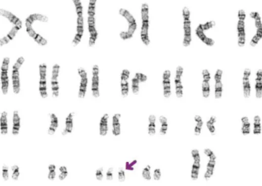 Figure 9 : Caryotype en bande G d'une T21 libre [Verloes et al., 2004]. 