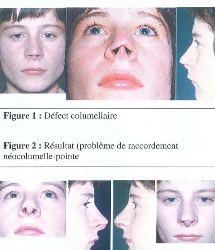 Figure 1 : Défect columellaire