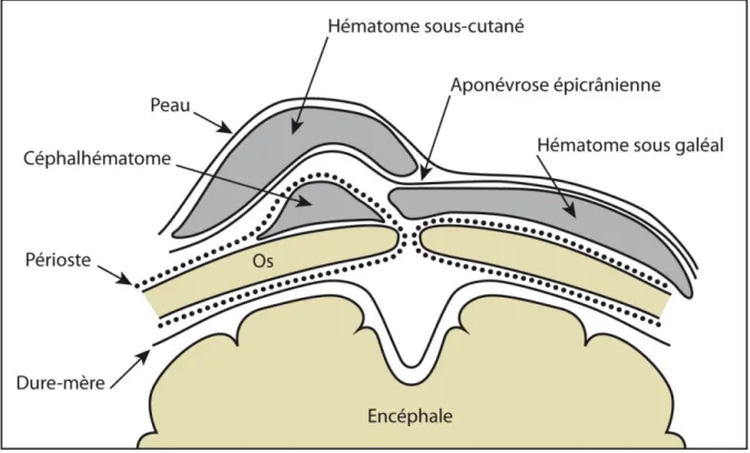 Figure 1: Hématomes du scalp 