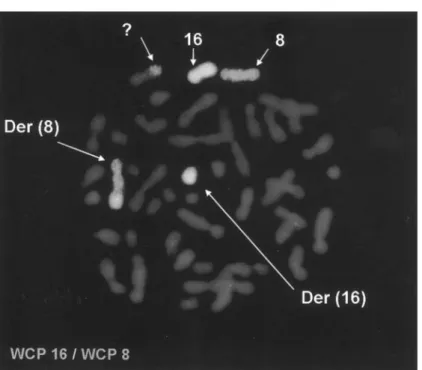 Figure 3: FISH using  WCP 8 and WCP 16  probes showed normal  chromosomes 8 and 16,  the derivative chromosome  8 stained by WCP 8 and  WCP 16 probes, the  derivative chromosome  16 partially stained by  WCP 16 probe and a third  derivative chromosome  par