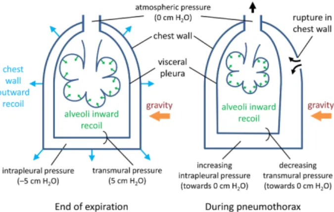 Figure 5: Schematic representation of the pneumothorax phe- phe-nomenon. Left, at end of expiration the lung is in equilibrium and there is no airflow
