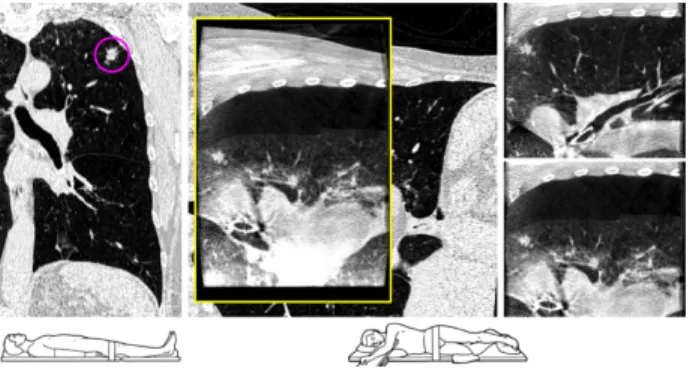 Figure 1: Left: preoperative CT image with the patient in supine position. Right: intraoperative CBCT images of the inflated (CBCT inf ) and deflated (CBCT def ) lung with the patient in lateral decubitus position